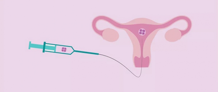Εμβρυομεταφορά: Πως γίνεται η διαδικασία;